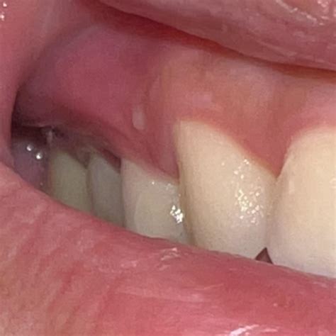 Painless circular white bump on gums, persisting for 2 months! Stayed ...