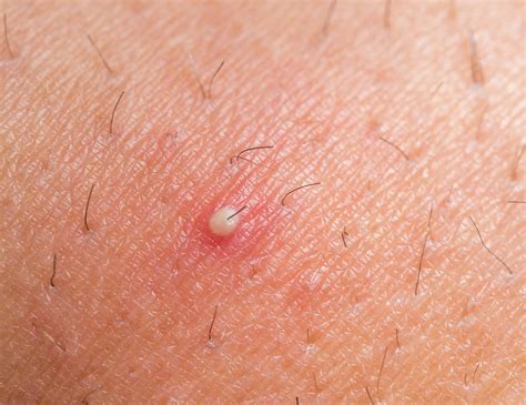 INGROWN HAIR - 5 BEST WAYS TO DEAL WITH IT