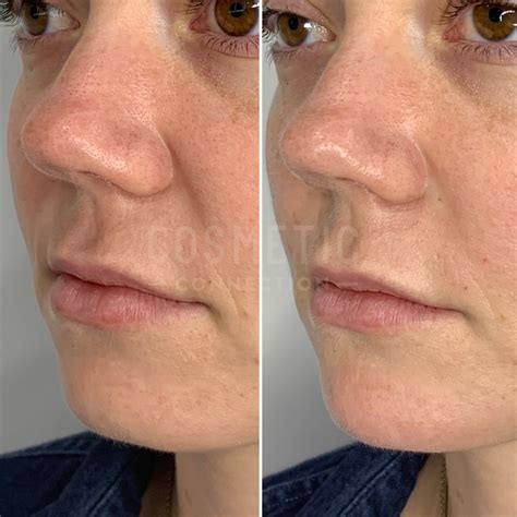 Juvederm Nasolabial Folds Before And After Nasolabial Folds Before And