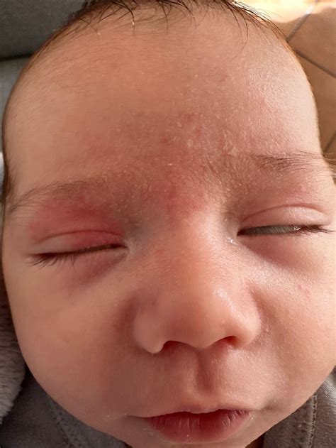 Salmon Patches | BabyCenter