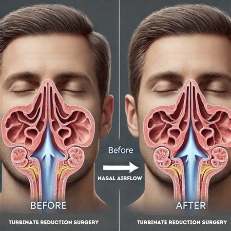 Turbinate Reduction Surgery