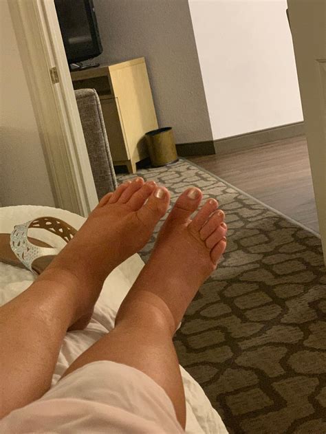 Pregnant Swollen Feet