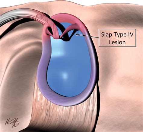 Shoulder Labrum Anatomy