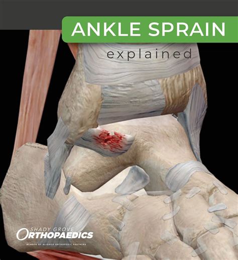 An ankle sprain occurs when the ankle rolls, twists, or turns and ...