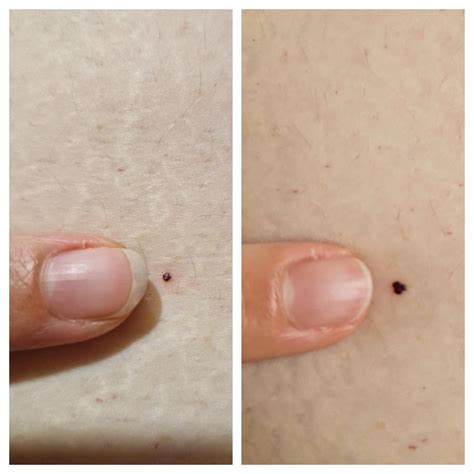 Black spot on leg? : r/AskDocs