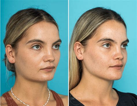 Jaw Implants Before And After