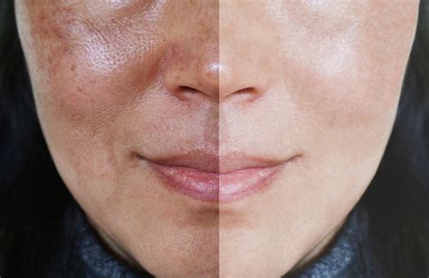 5 treatments to treat uneven skin tone - Hush LA Medspa