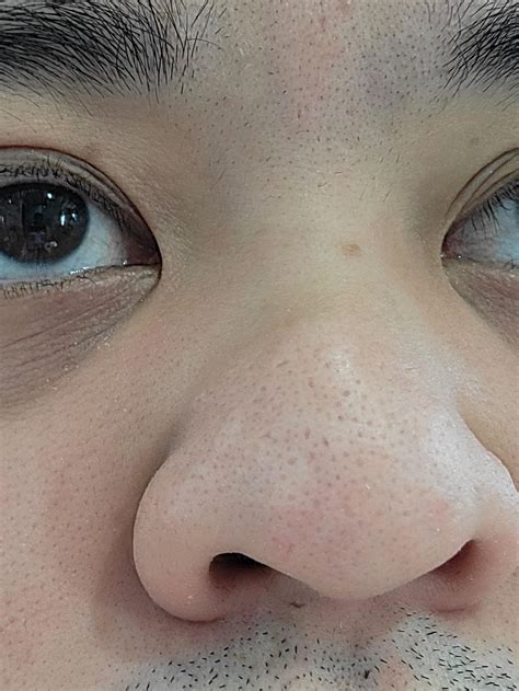 [Acne] Anyone here have hypertrophic acne scars treated with either microneedling or fraxxel ...