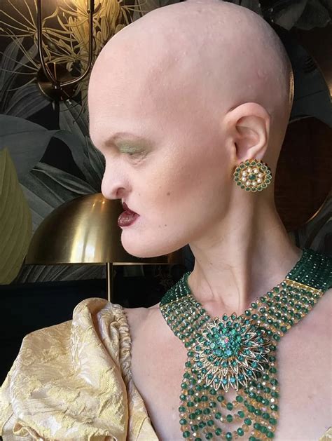 6 Potret Melanie Gaydos, Model Sukses yang Idap Kelainan Genetik