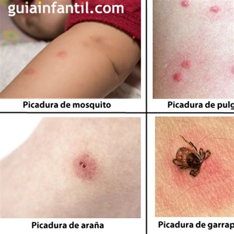 Imágenes De Las Etapas De La Picadura De Araña