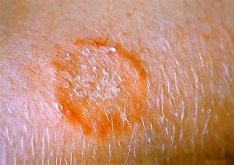 Beginning Stages Of Ringworm