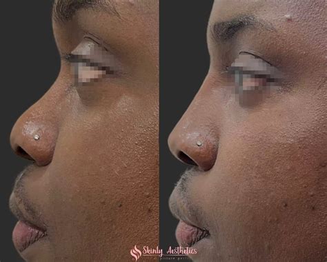 Non-Surgical Rhinoplasty - Before and After Results
