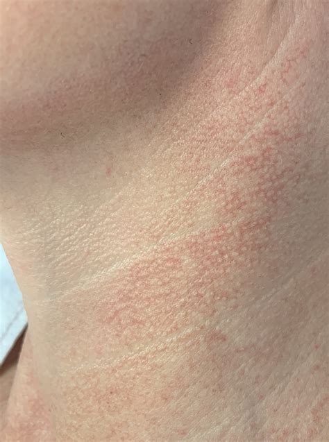 Poikiloderma van Civatte | Huid & Laser Utrecht