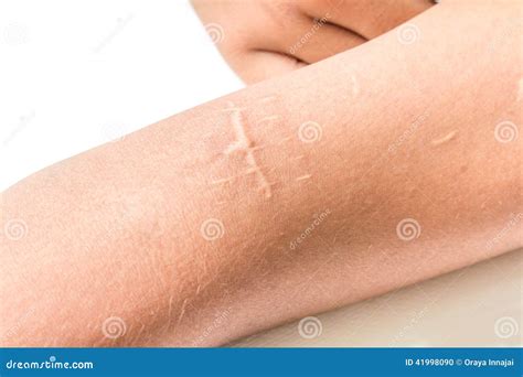 Scar Of Cutdown Royalty-Free Stock Image | CartoonDealer.com #41998090