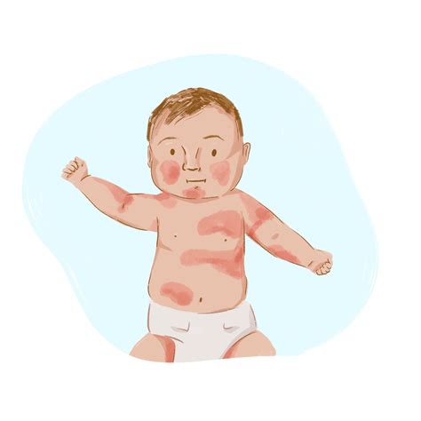 How To Clean Baby Face With Eczema / How To Treat Eczema Especially When It S Severe Glamour ...