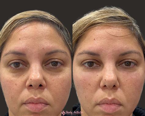 Under Eye Fillers - Before & After Results at Skinly