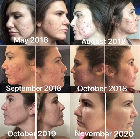 Cystic Acne Scars & My Mental Health • TheJJAdventures