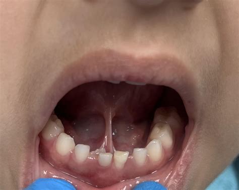 Dr Cameron Tongue Tie at Priscilla Carollo blog