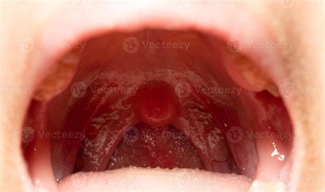 Sore throat with throat swollen. Closeup open mouth with posterior ...