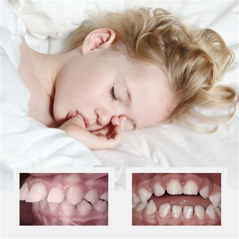 6 Tips to Prevent Mouth Breathing in Infants and Children - Family ...