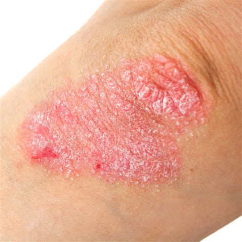 Eczema Flare Up Due To Heat at Brandi Hayes blog