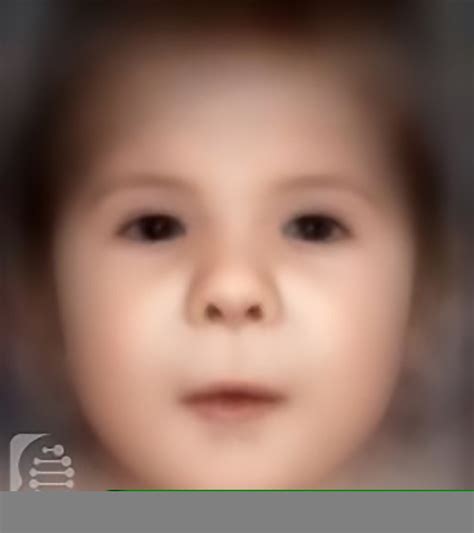 Freeman Sheldon Syndrome The UnLIMBited Foundation | Meet Hollie, A