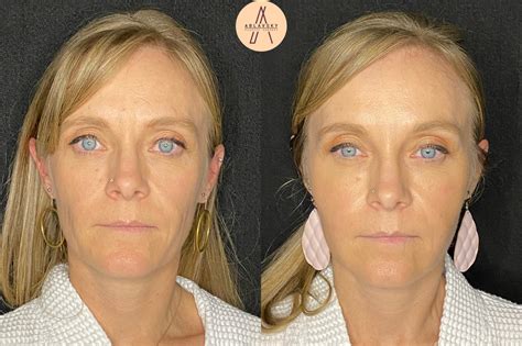 Facial Fat Grafting Healing Time at George Farrow blog
