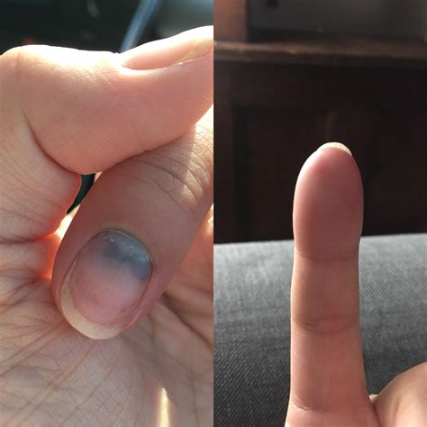 How To Relieve Pressure From A Smashed Finger - Trackreply4