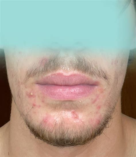 Gram Negative Folliculitis Face DermDx: Itchy Rash On Face And Neck