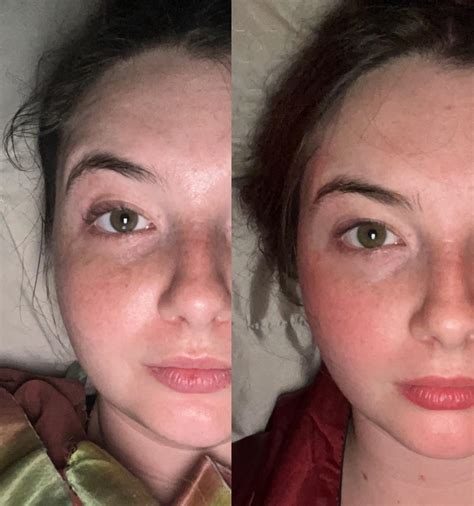 1 Day before vs 30 days After Nexplanon Removal : r/Nexplanon