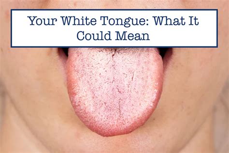 Dehydration Cause White Tongue Why Your Tongue Is White The Tongue Is