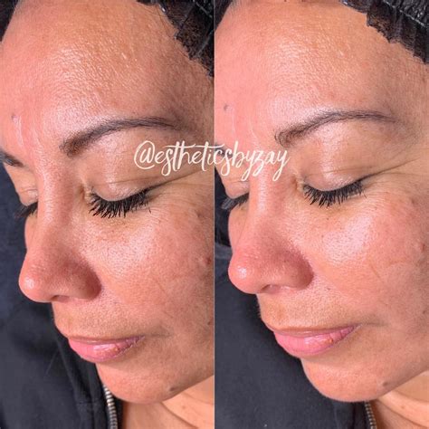 Before/after microdermabrasion facial with a custom jelly mask 😍 I ...