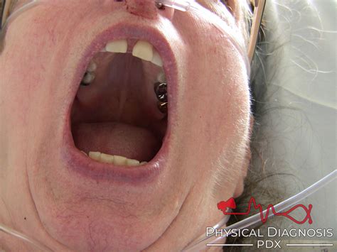 What Causes A High Palate at Joe Jennings blog