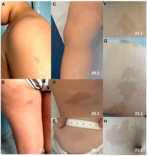Heterozygosity for loss-of-function variants in LZTR1 is associated ...