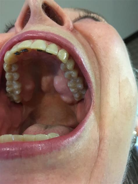 Bones Inside Mouth Under Tongue