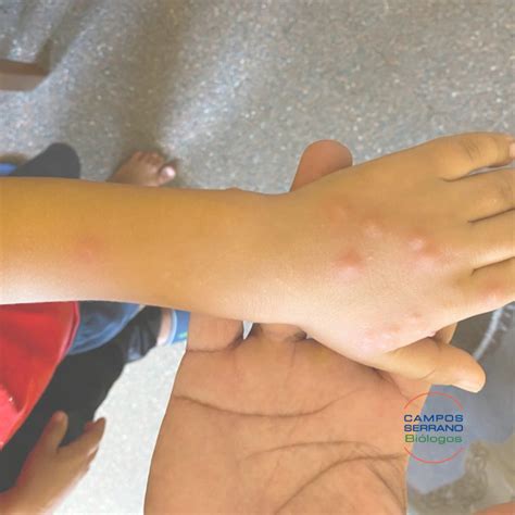 Picadura de chinches - Campos Serrano Biólogos