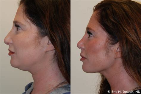 Eric M. Joseph, MD | Rhinoplasty Before & After: Deviated Septum Repair ...