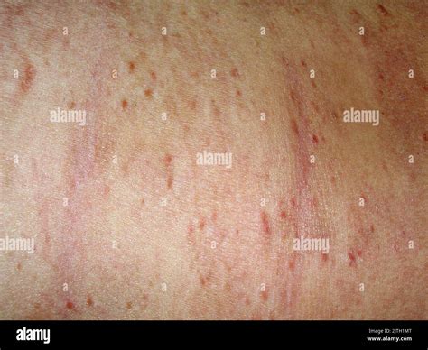 Pityriasis lichenoides chronica Stock Photo - Alamy