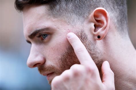 Healed Smallpox Scars