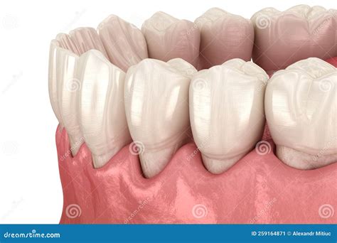 Gum Recession Process. Medically Accurate 3D Illustration Stock Illustration - Illustration of ...