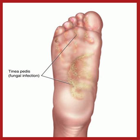What Does Athlete's Foot On Heel Look Like at Beau Galway blog