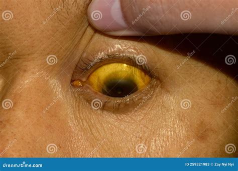 Deep Jaundice in Asian Male Patient. Yellowish Discoloration of Skin ...