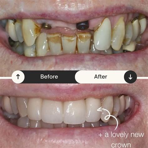 Screwless Dental Implants – The Only Times to Use Them