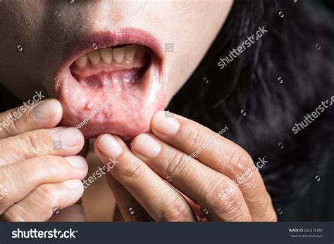 Photo de stock Tumeur dans la bouche, MUCOCELE LIP. 662310340 | Shutterstock
