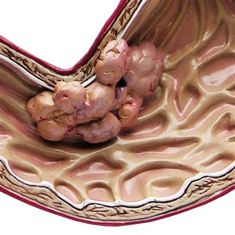 Câncer de estômago: Causas, sintomas e tratamentos - Osasco Notícias