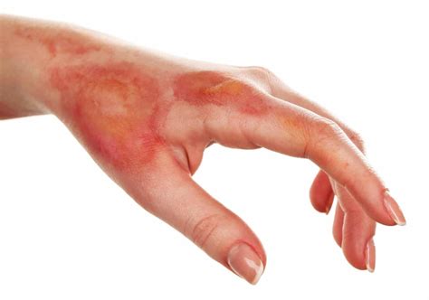 Burn Healing Stages: Healing Process for Burns and Scalds