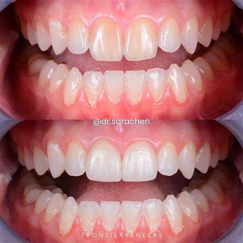#frontierveneers #calcificmetamorphosis #veneers #cosmeticdentistry # ...