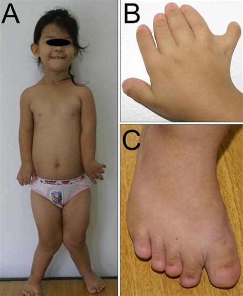 Ellis van Creveld syndrome causes, symptoms, diagnosis, treatment ...