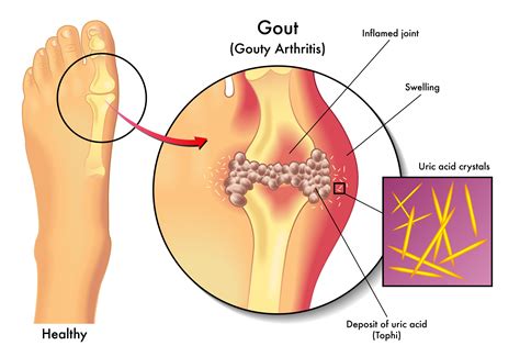 What is Gout? What are the Symptoms of Gout?