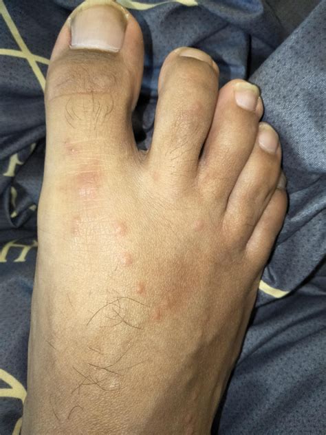 Do Bed Bugs Bite Toes at Odessa Anderson blog